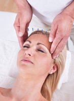 Haaruitval acupunctuur behandeling en haarverlies tegengaan | Body2balance.nl