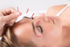 Cosmetische acupunctuur | Facial acupuncture 